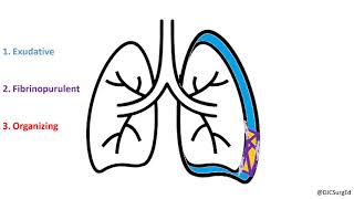 Empyema and Pleural Effusions [upl. by Tiffa377]