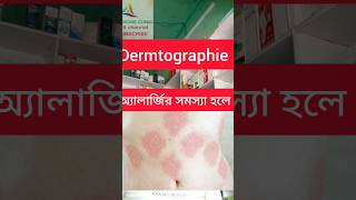 Allergy urticaria Dermtographie Bengali [upl. by Nivej]