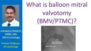 What is balloon mitral valvotomy BMVPTMC [upl. by Cherry412]