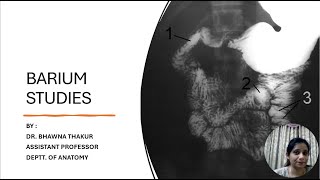 BARIUM STUDIES KEY POINTS FOR EXAM [upl. by Ameehs]