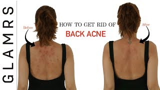 How To Get Rid of Back Acne the Natural Way  Effective Home Remedies [upl. by Erdnaed]