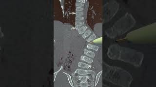 Scoliosis with Hemi vertebra  Treatment options  when surgery should be done spine pune doctor [upl. by Fotzsyzrk30]