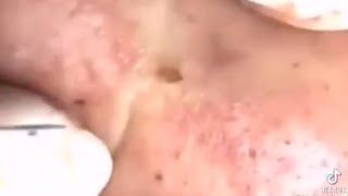 SQUEEZE BLACKHEADS and PIMPLES Blackheads Extrations [upl. by Oiramaj]