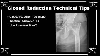 Closed reductions for intertrochanteric femur fractures [upl. by Rriocard]