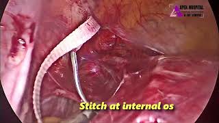 Laparoscopic Abdominal Cerclage by Dr R K Mehta  Apex Hospital Sirsa [upl. by Arraes]