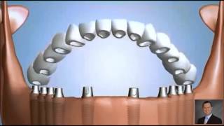 Ten Dental Implants Fixed Bridge [upl. by Gilburt]