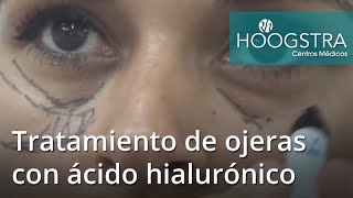 Tratamiento de ojeras con ácido hialurónico 19035c [upl. by Molton]