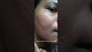 1 Month Using Tretinoin Daily to see the effect viralvideo tretinoin shorts youtubeshorts [upl. by Myrta391]