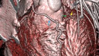 Coronary Artery Anatomy 12 [upl. by Singleton]