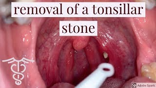 Removal of a tonsillar stone  patient education video by Dr Carlo Oller [upl. by Ardnat]