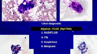 Thyroid Cytology I Approach [upl. by Rebm]