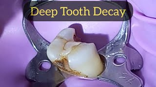 Deep Tooth Decay Removal Procedure  Premolar Caries Removal and Access Opening [upl. by Rocco561]