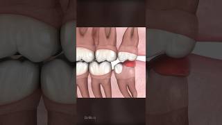 Should You Remove Wisdom Teeth [upl. by Wehtta]