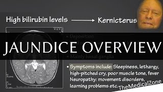 Jaundice Overview  Definition and Pathology Including neonatal jaundice [upl. by Keheley]