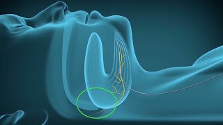 A New Way to Treat Sleep Apnea  Hypoglossal Nerve Stimulator  CHI Health [upl. by Arod]