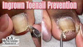 Excessive Toenail Build Up Pedicure Transformation [upl. by Bebe]