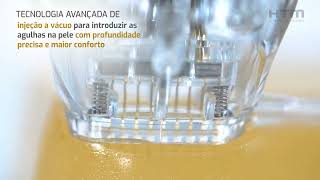 Apresentação Needle RF  Radiofrequência Microagulhada HTM [upl. by Ambrose]