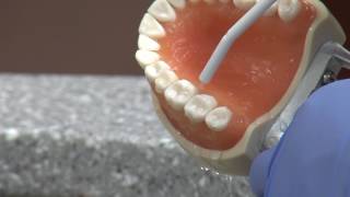 New cavity treatment offers no drilling no filling [upl. by Elinet436]