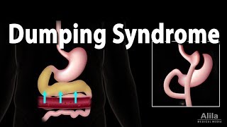 Dumping Syndrome Animation [upl. by Kcirred228]