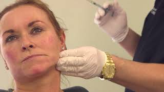 Full face filler treatment  nonsurgical volumetric facelift [upl. by Otero839]