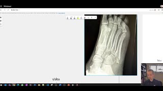 My experience with fifth metatarsal fracture  recovery timeline UK NHS what you should expect [upl. by Grady]