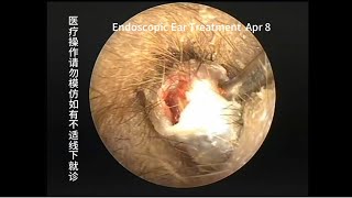 A case of cholesteatoma misdiagnosed as cerumen embolism [upl. by Pillihp]