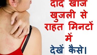 दाद खाज खुजली का घरेलू उपचार daad khaj khujli ka ilaj stop uncontrollable itching home remedies in h [upl. by Lavinia]