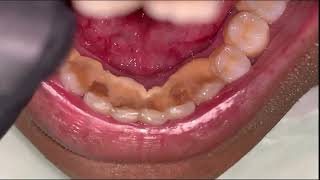 Limpieza de Sarro Dental Supragingival y Subgingival [upl. by Jonie562]