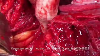 CESAREAN SECTION IN PLACENTA INCRETA UTERUS CONSERVE [upl. by Kusin]