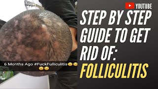 Step by step guide to get rid of folliculitis [upl. by Karolina303]