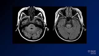 Neuroradiology board review lecture 1 case 19 [upl. by Awahsoj]