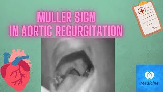 müller sign Aortic regurgitation  muller sign medicine physical examination [upl. by Perkoff]