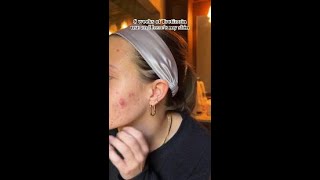 Cystic Acne Solutions 8 Weeks on Tretinoin [upl. by Abdu]