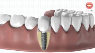 Vidéo de démonstration pour une pose dimplant dentaire [upl. by Julis272]