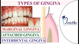 Gingiva anatomy  Gingiva types  Carranza  Marginal Attached amp Interdental Gingiva Periodontology [upl. by Ulrick]