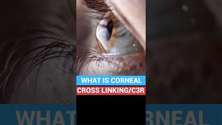 Corneal cross linking C3R  Keratoconus Treatment Cost [upl. by Leon]