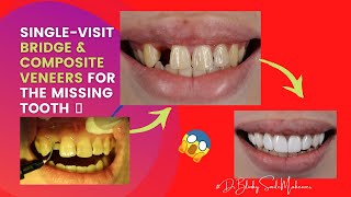 One missing tooth replacement composite veneers dental smile foryounewvideo vlog youtube [upl. by Song]