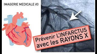 IMAGERIE MEDICALE 3  Prévenir et traiter linfarctus grâce à langiographie [upl. by Laure168]