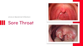 Sore Throat Viral or Bacterial Infection [upl. by Yarrum]