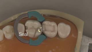 Class II Composite Restoration  Stevenson Dental Solutions [upl. by Nosac]