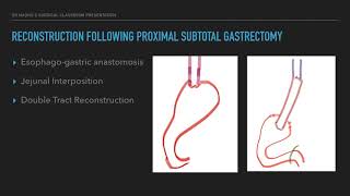 Surgical Management in Carcinoma Stomach Part 2  Digestive Tract Reconstruction [upl. by Pigeon682]