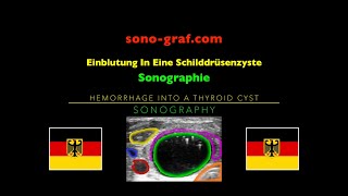 Sonographie  Einblutung In Eine Schilddrüsenzyste [upl. by Gretta641]