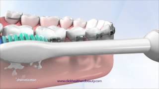 How to use your Philips Sonicare Toothbrush perfect for braces too [upl. by Warfield]