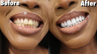 😮 Top 2 Natural Ingredients To Whiten Teeth At Home WITHOUT Hydrogen Peroxide Alkaline [upl. by Maryjane]