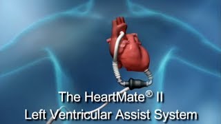 The HeartMate II Left Ventricular Assist System [upl. by Onibla255]