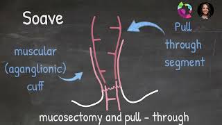 Anatimations Surgical Options for Hirschsprung Disease [upl. by Weinreb]