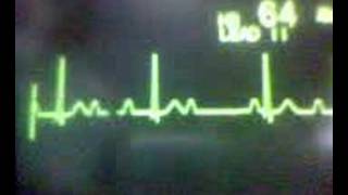 ECG Video AV Block  Second Degree Type 1 Wenckebach [upl. by Macdermot839]