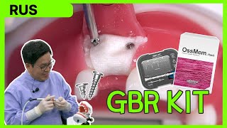 Практические советы GBR KIT  Операция в зоне зуба 11 [upl. by Enilasor52]