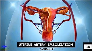 Uterine Artery Embolization  Tumor Cell Removing Surgery [upl. by Yebloc]