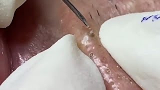 Painstaking Super Satisfying Pimple Relaxing Skincare [upl. by Grodin]